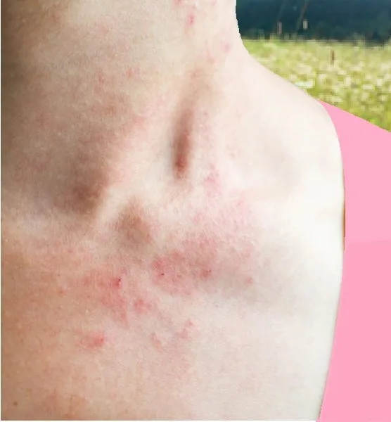 Červené skvrny na kůži v oblasti krku a hrudníku.